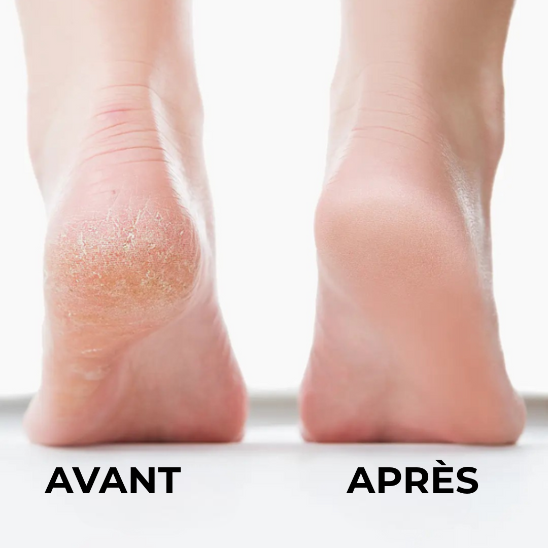 Éliminateur de callosités professionnel