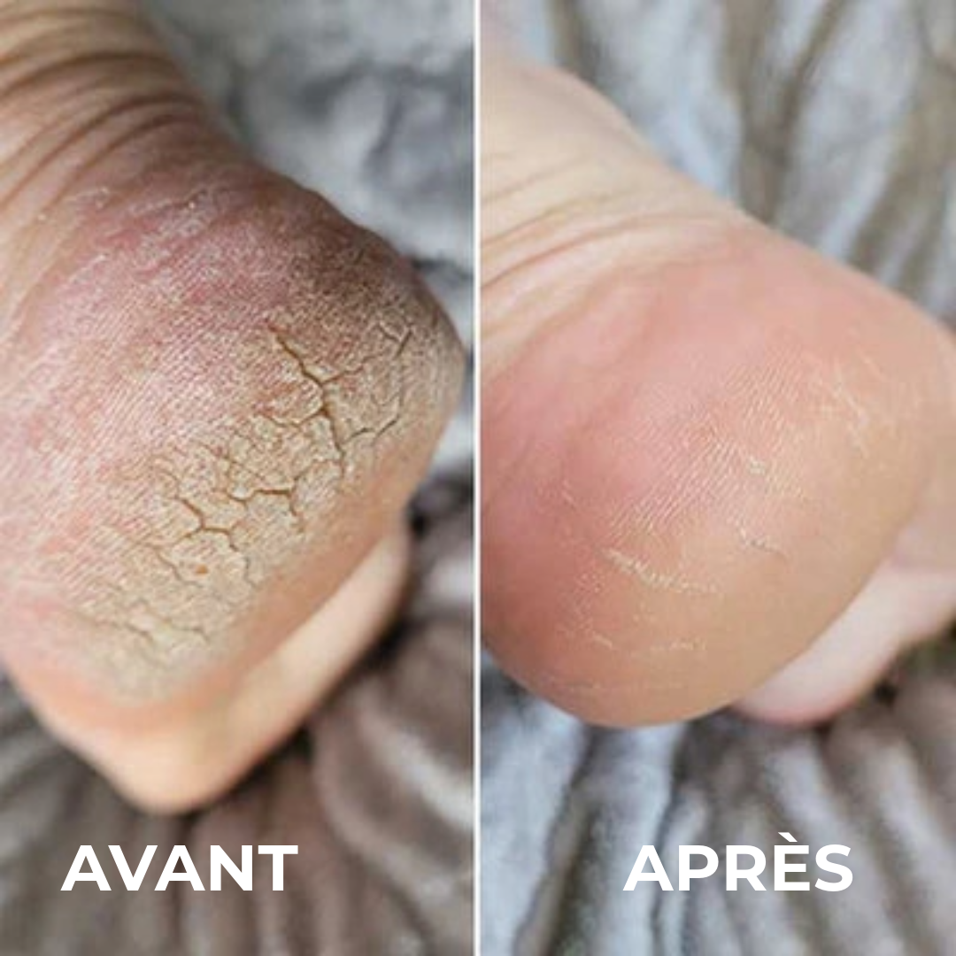 Éliminateur de callosités professionnel