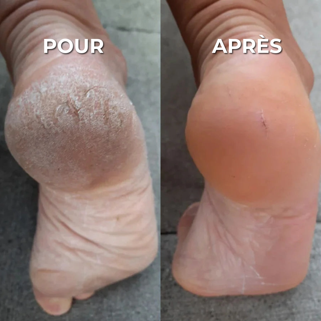 Novaloza™ | Éliminateur de Callosités Professionnel