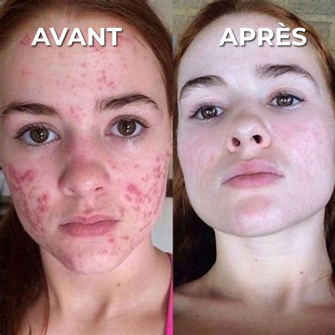Crème professionnelle pour les cicatrices